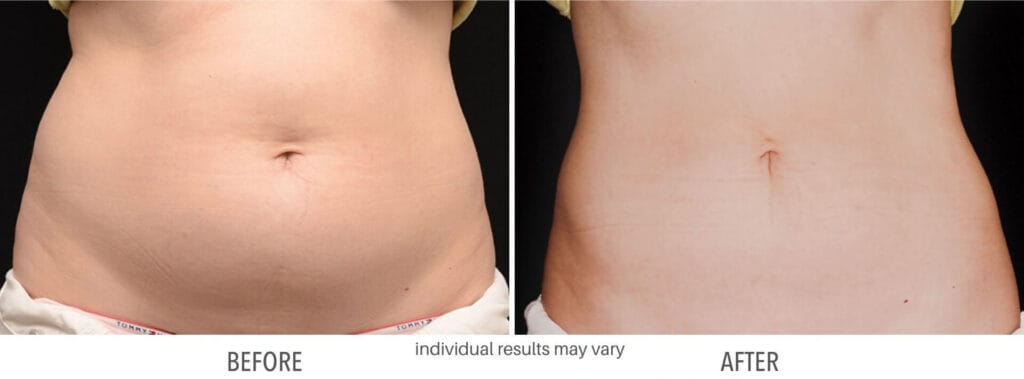 coolsculpting stomach area